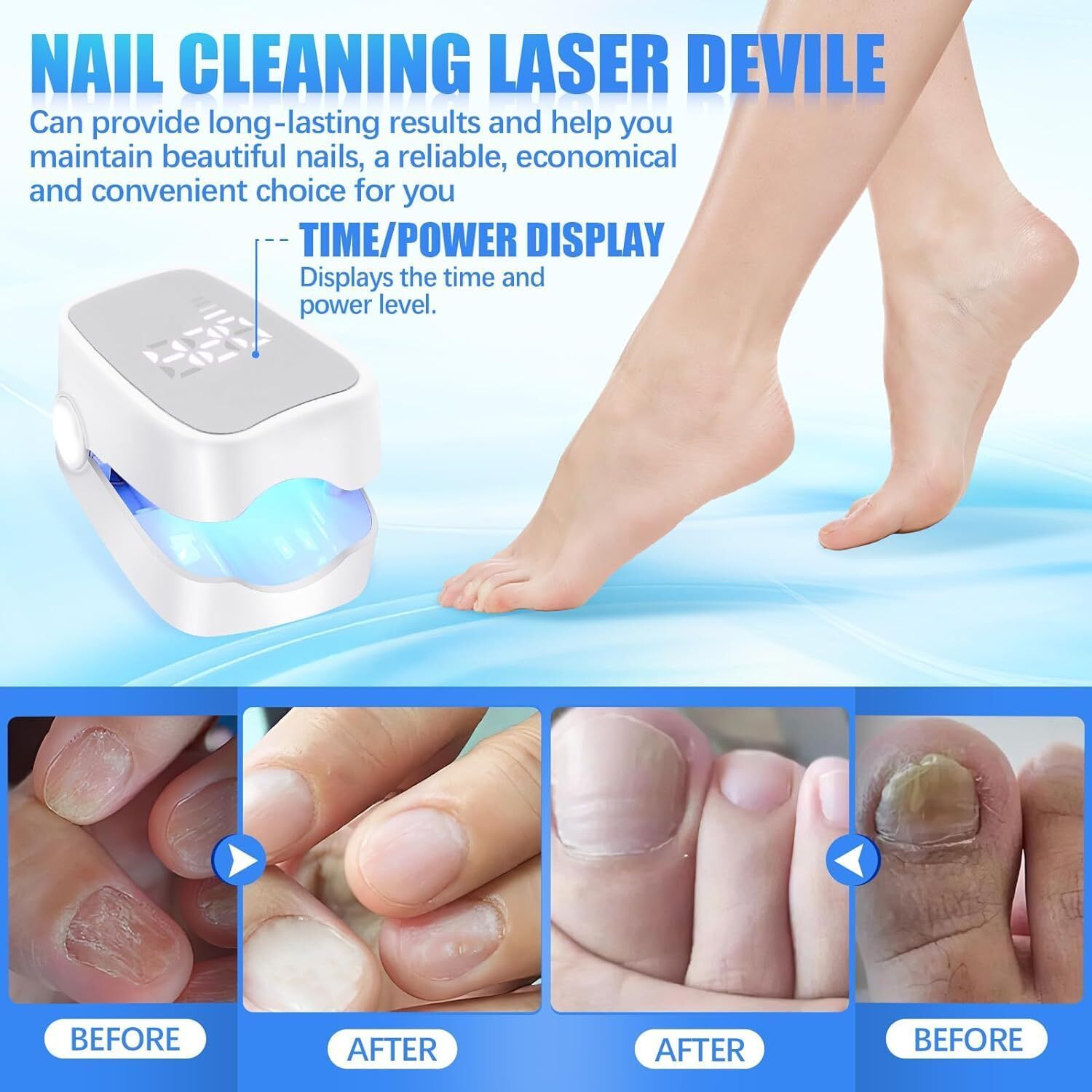 Advanced Nail Fungus Laser Removal Device For Toe And Finger Fungal Infection