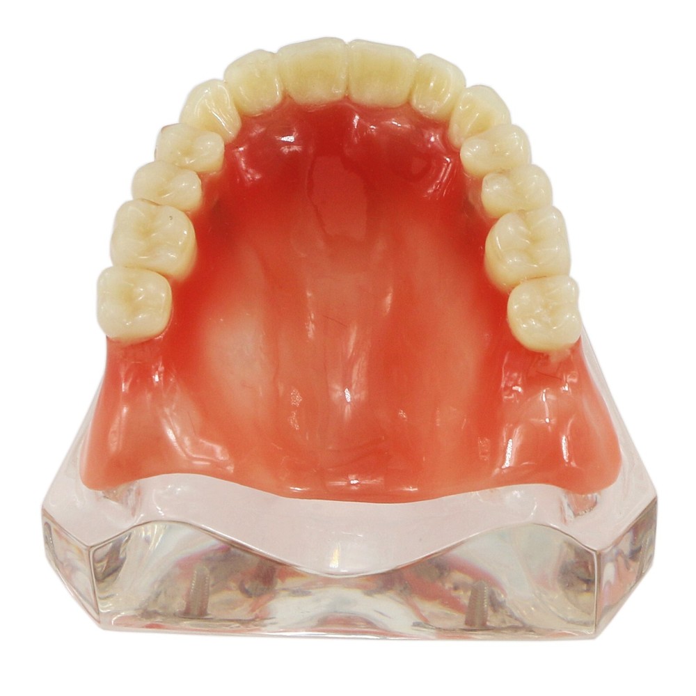 Dental Typodont Implant Overdenture Teeth Model 4 Implants Upper Lower