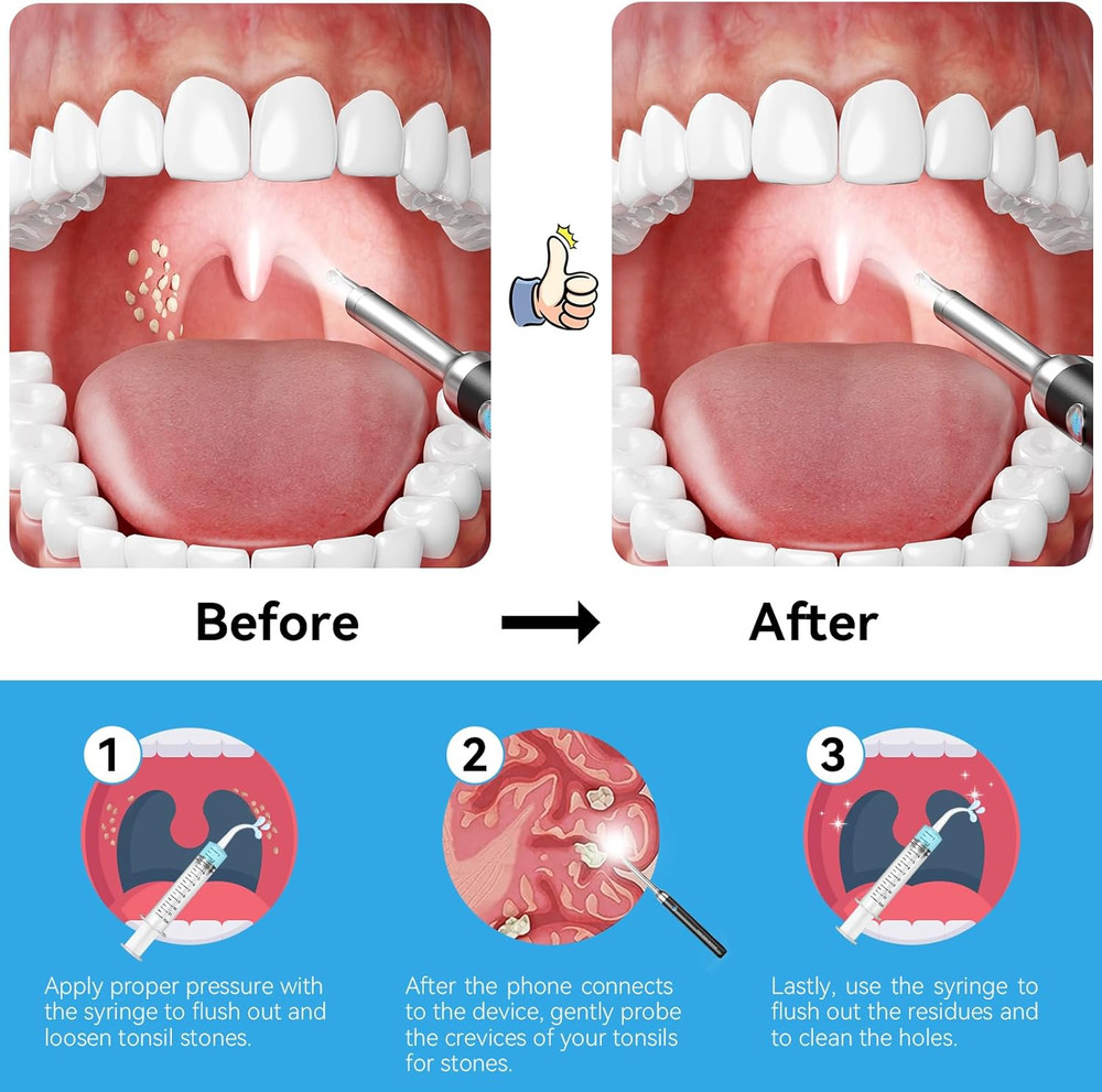 2025 Upgraded Tonsil Stone Remover with Camera, Visual Tonsil Stone Removal Kit
