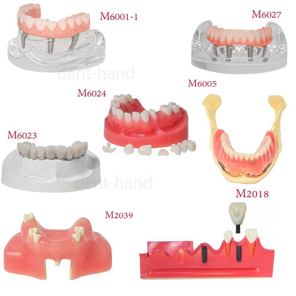 Dental Overdenture Typodont Implant Restoration Model  Practice Demo Type Model