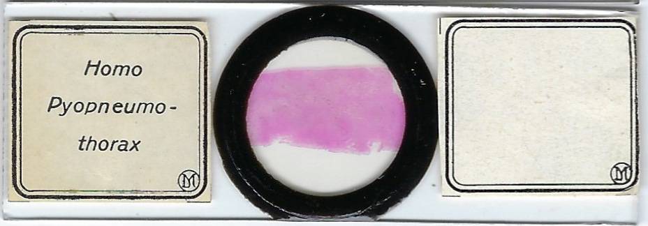 Human Pyoneumothorax Pathology Microscope Slide by Moeller