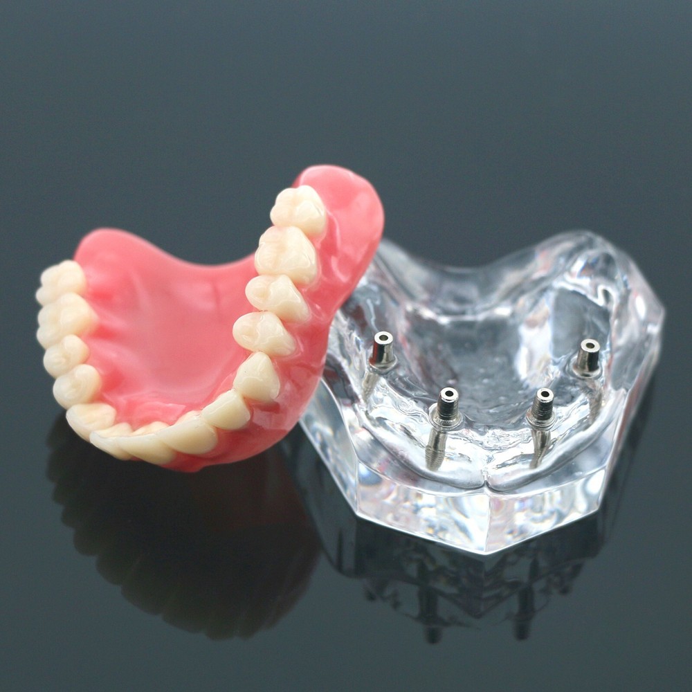 Dental Typodont Implant Overdenture Teeth Model 4 Implants Upper Lower