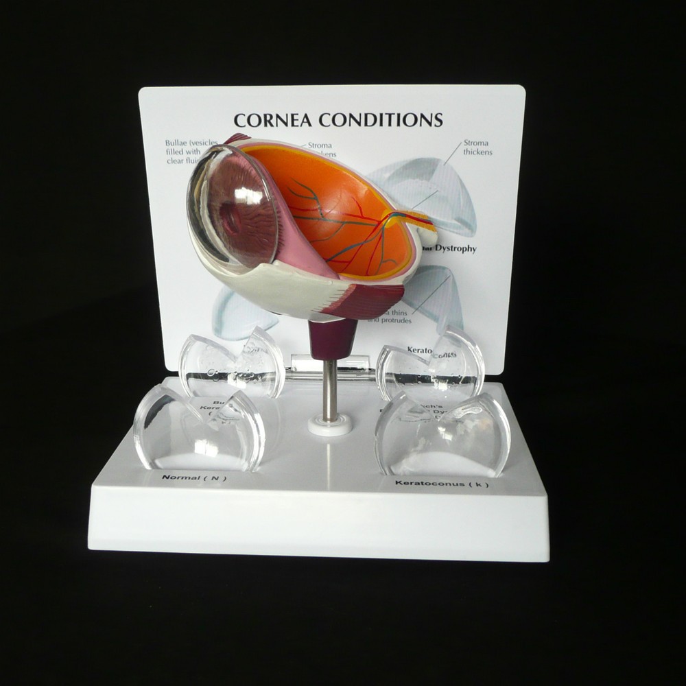 Anatomical Human Corneal Disease Model
