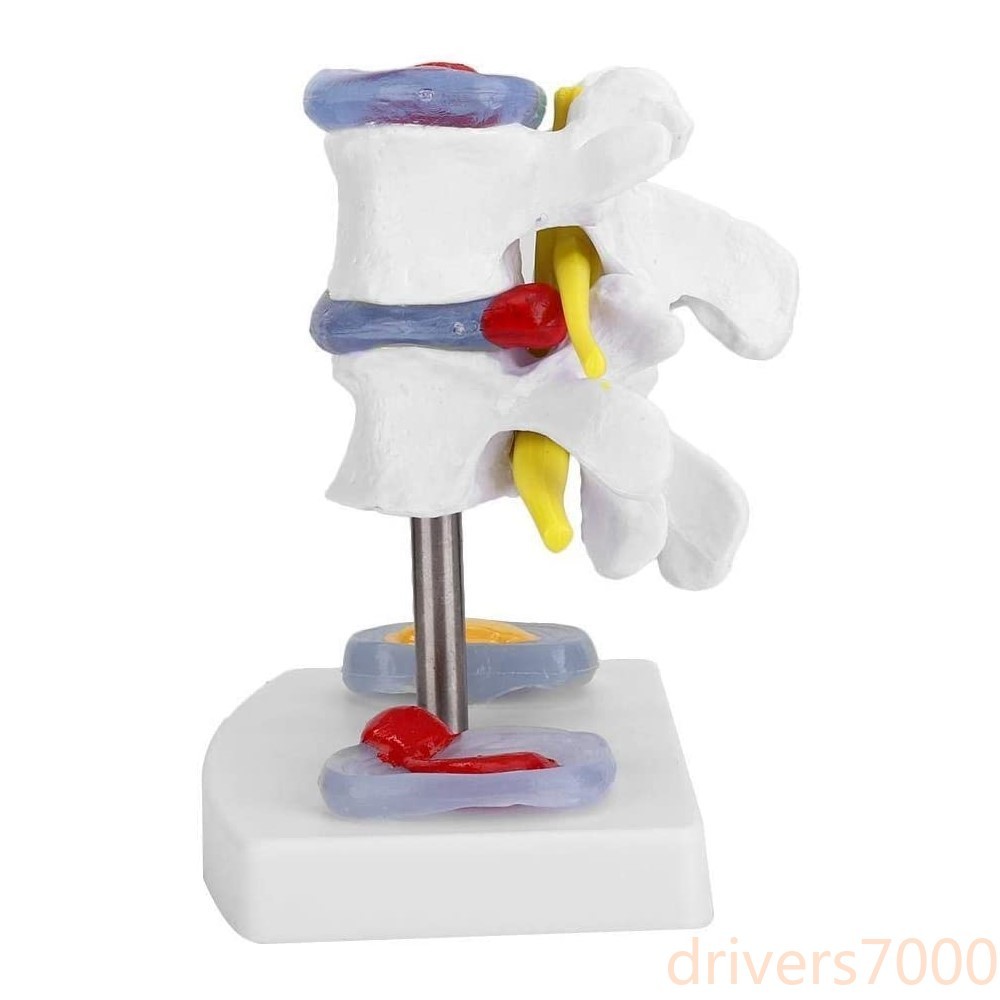 Anatomical Lumbar Disc Herniation Demonstration Model Human Spine