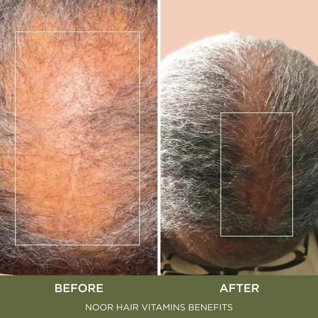 5 Pack NOOR HAIR Healthy Hair Formula,Hair Growth Suplement Supportig Thick Hair