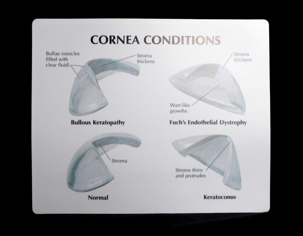 Anatomical Human Corneal Disease Model