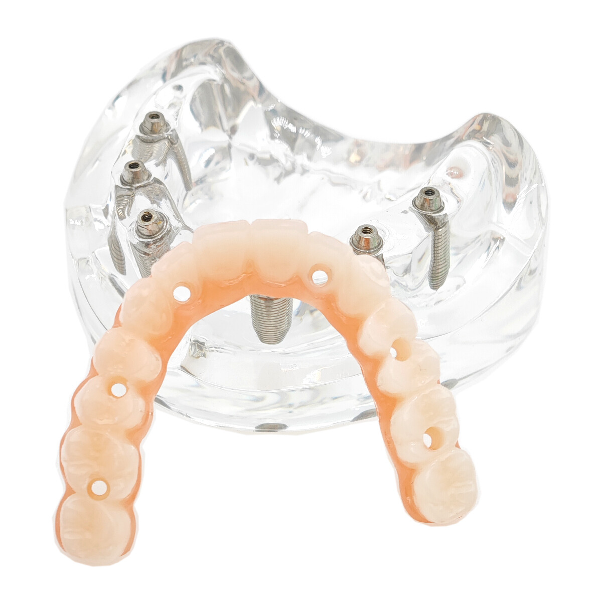 Dental Upper/Lower 4/6 Implants Demo Implant Teeth Model Restoration Overdenture