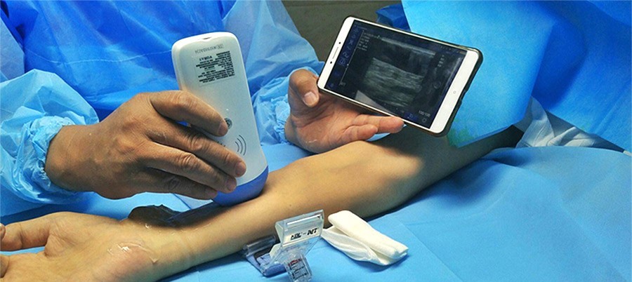 Wireless Linear Palm B/W Ultrasound Scanner – Portable Probe Type, 128 Elements