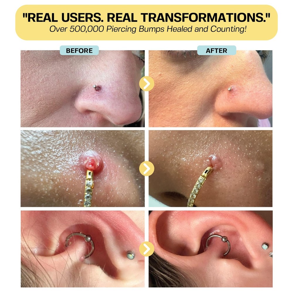 Piercing Bump & Keloid Bump Removal Solution | Soothing Piercing Aftercare | ...