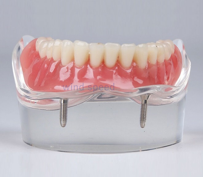 Dental Typodont Teeth Study Teach Model Implant Endo Caries Demonstration