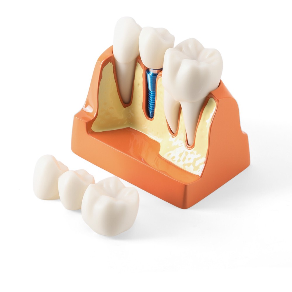 Dental 4Times Teeth Model Implant Analysis Crown Bridge Removable Study Training