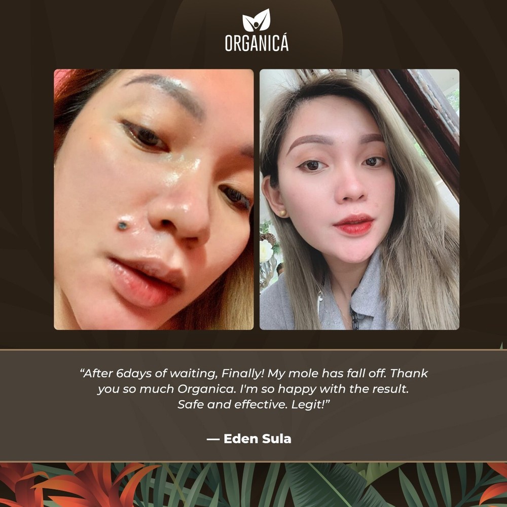 Multi-Awarded Mole and Warts Remover Set