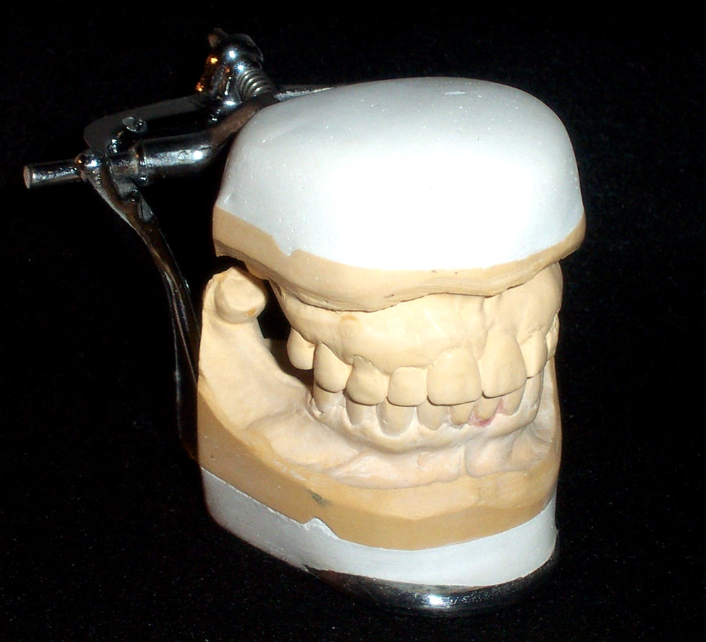 Overbite - Vintage Dental Articulated Model Teeth