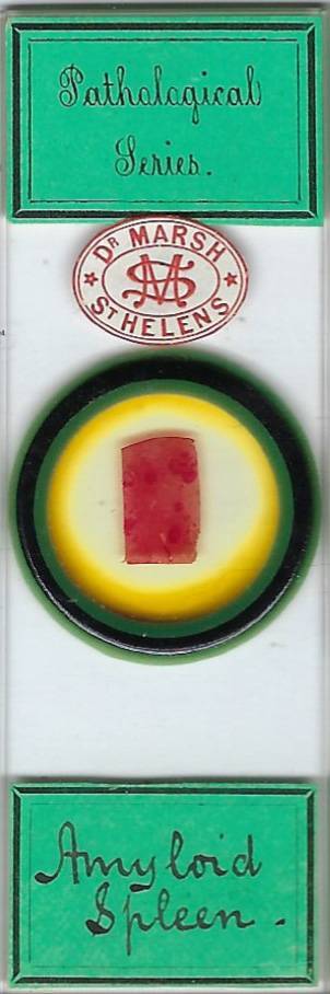 Human Amyloid Spleen Pathology Microscope Slide by Dr. Sylvester Marsh