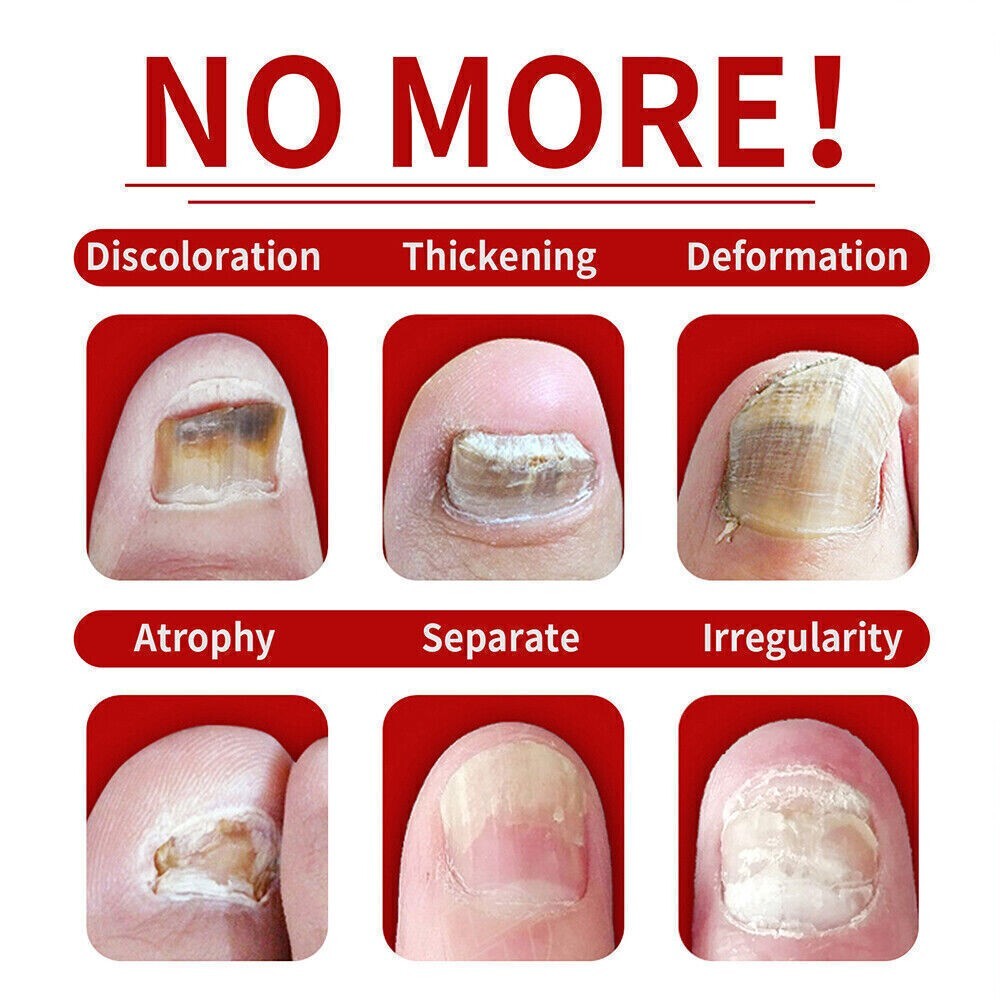 Toenail Fungus Laser Device Nail Repair Solution Toenail Fungus Laser Device