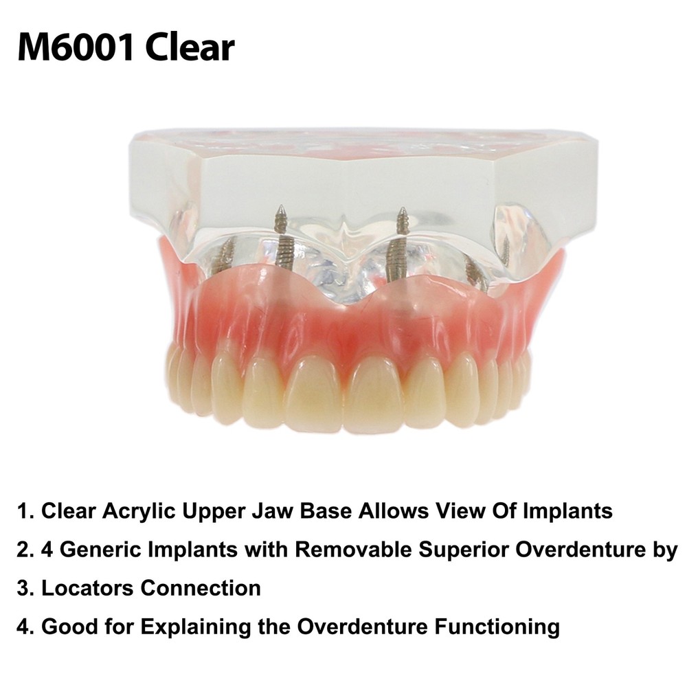 Dental Teeth Model Overdenture Removable Teeth Upper/Lower Jaw 4 Implants Model