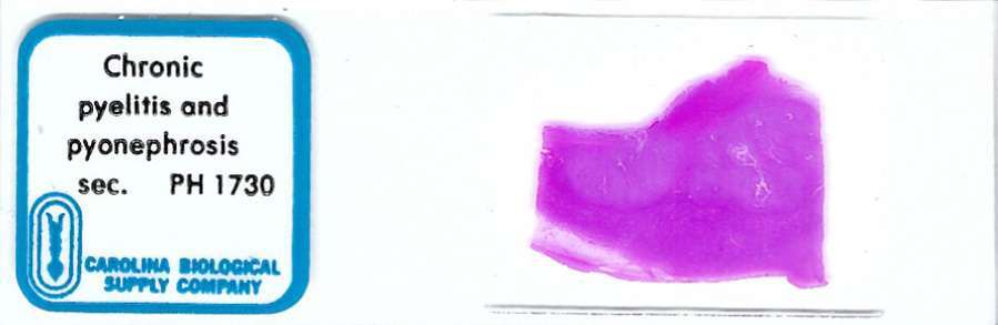 Human Chronic Pyelitis and Pyonephrosis Pathology Microscope Slide