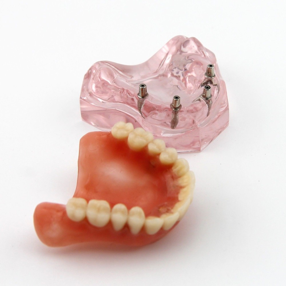 Dental Implant Teeth Model Demo Overdenture Restoration Teaching Study 4 Models