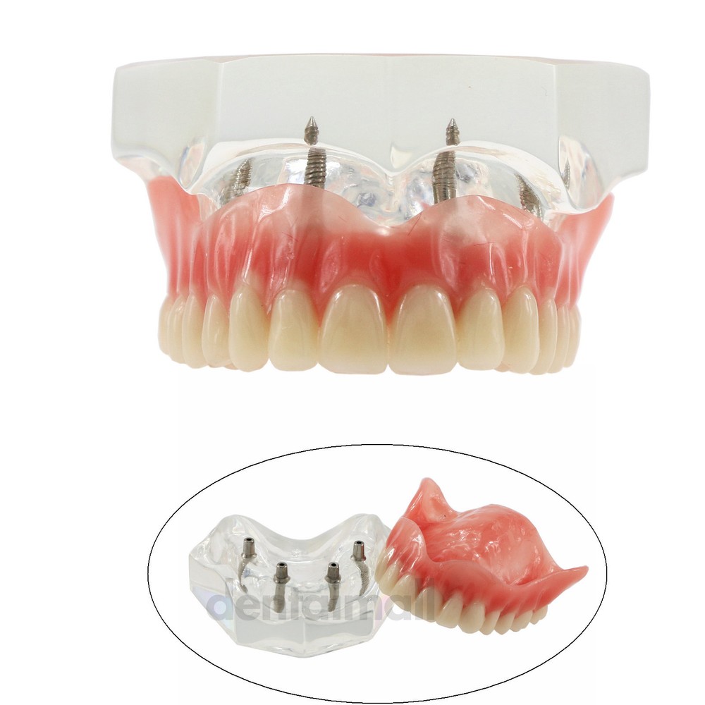 Dental Implant Teeth Model Restoration Overdenture Upper/Lower 4 Implants Demo