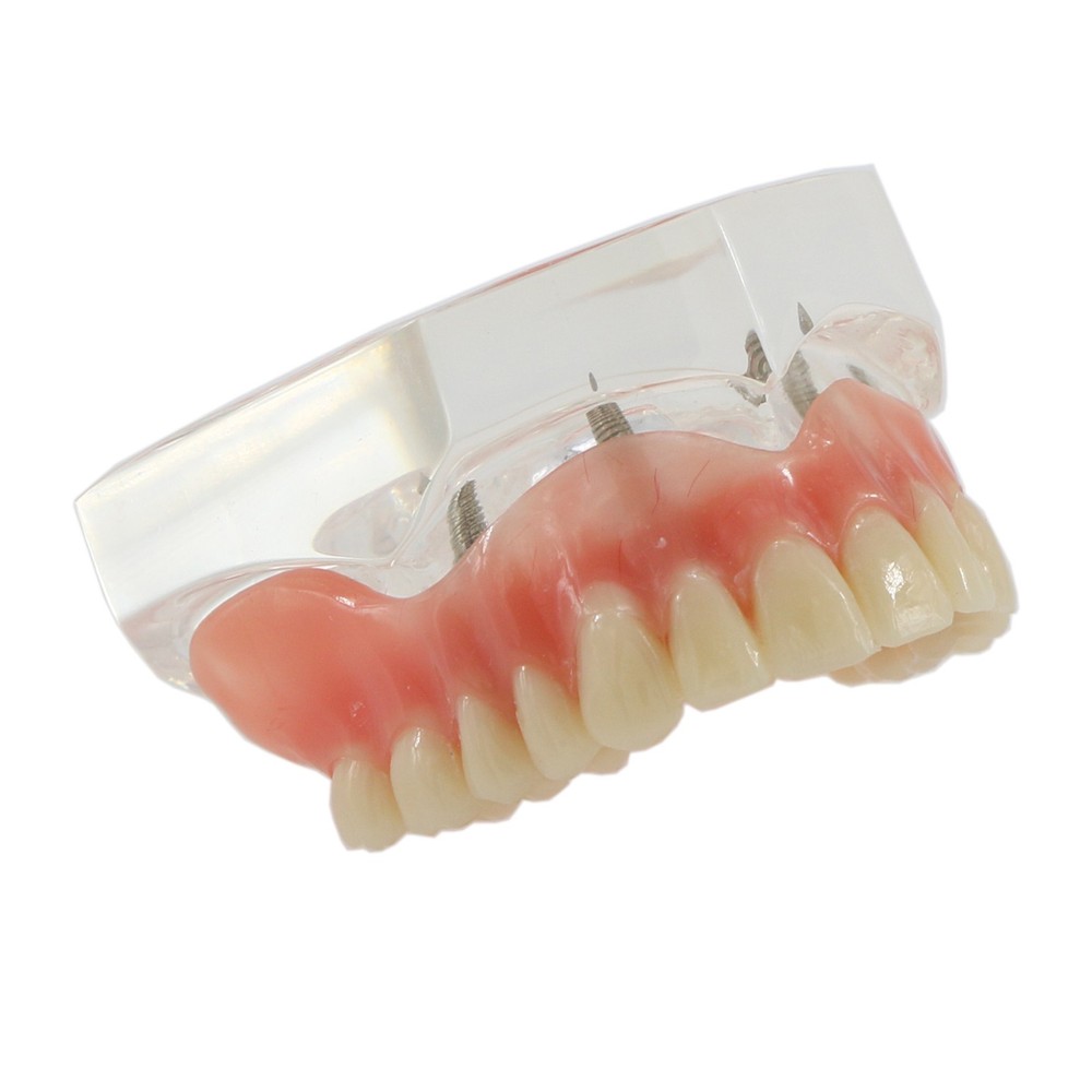 Dental Teeth Model Overdenture Removable Teeth Upper/Lower Jaw 4 Implants Model