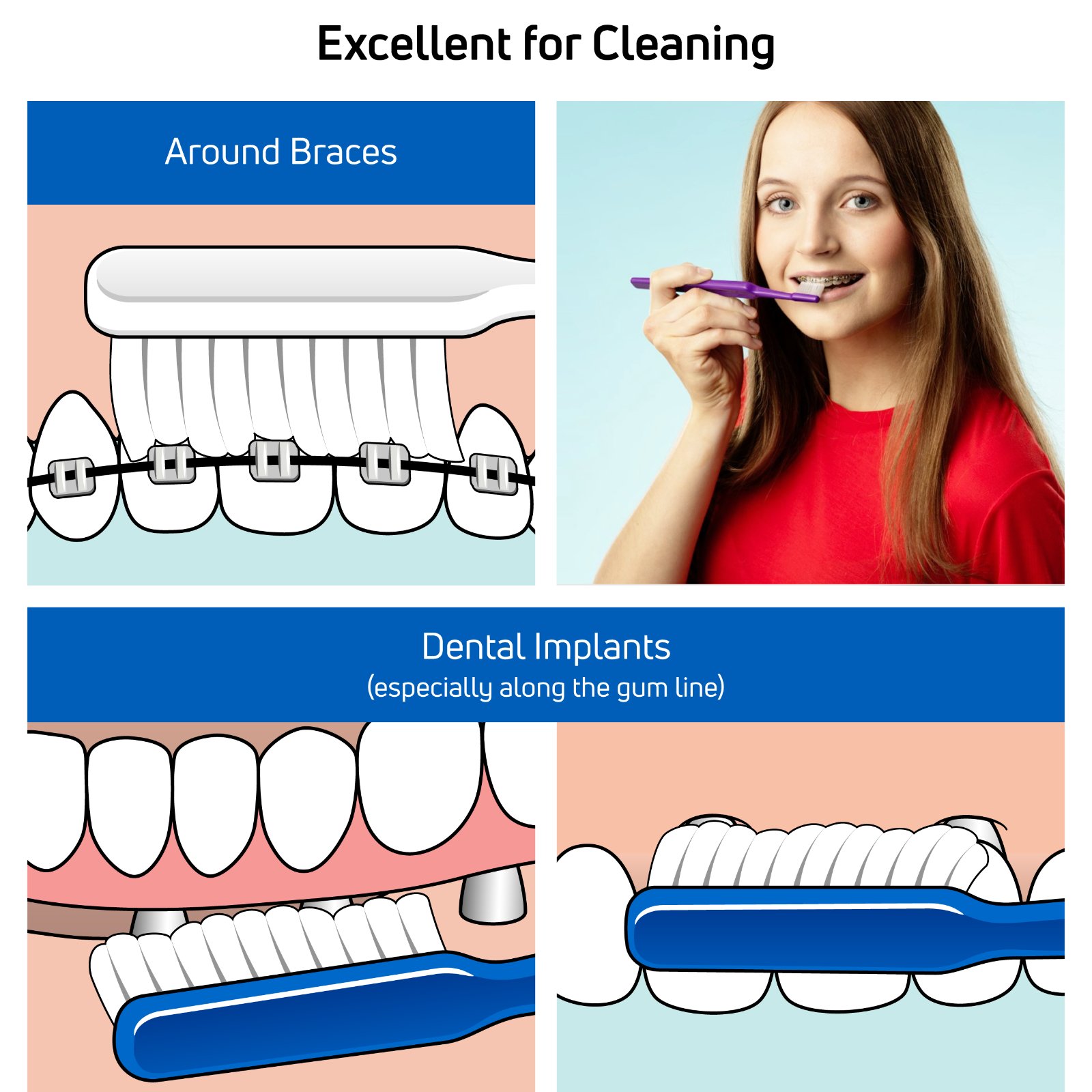 TEPE Implant Orthodontic Soft Toothbrush – Cleaning Implants & Fixed Braces 1Pk