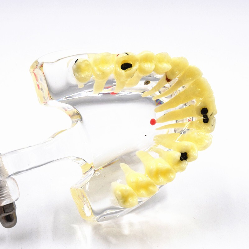 Dental Disease Teeth Model Pathological Transparent Adult Teaching Study 1 Pc