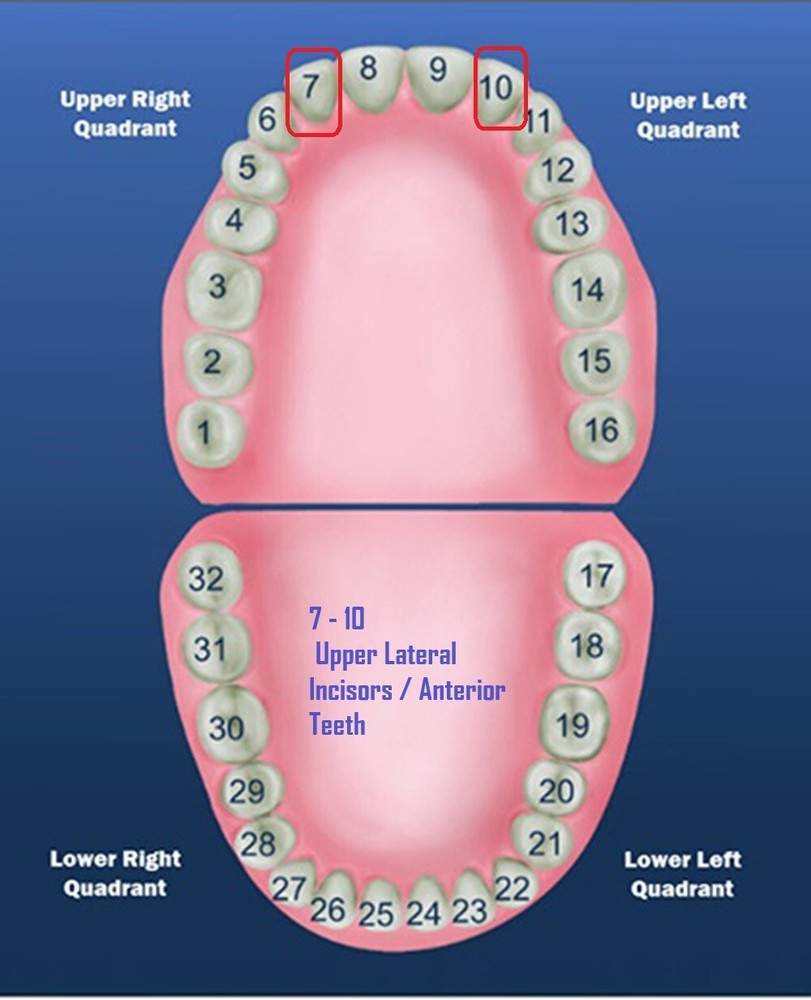 DENTAL POLYCARBONATE TEMPORARY CROWNS #29 (ULL) UPPER LEFT LATERAL 5/PACK