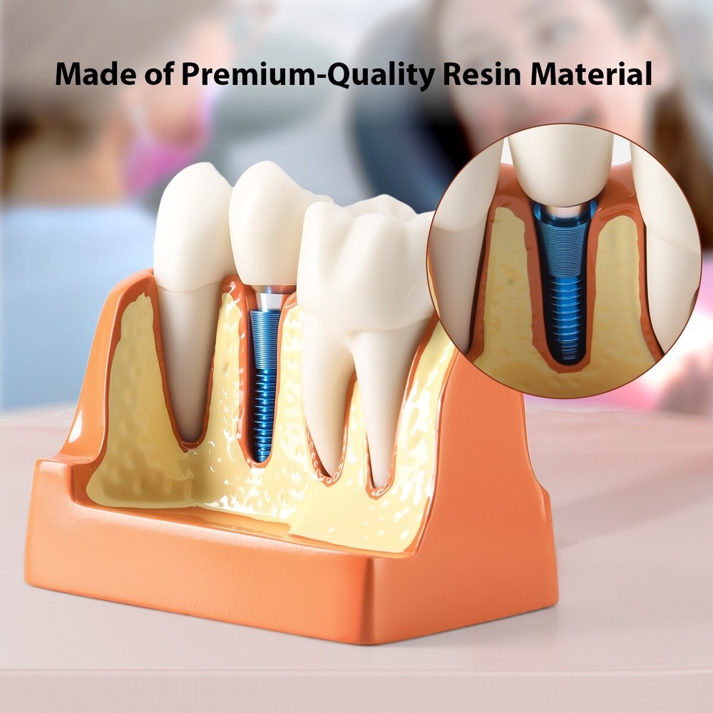 4 Times Dental Analysis Crown Bridge Demonstration Removable Teaching Model