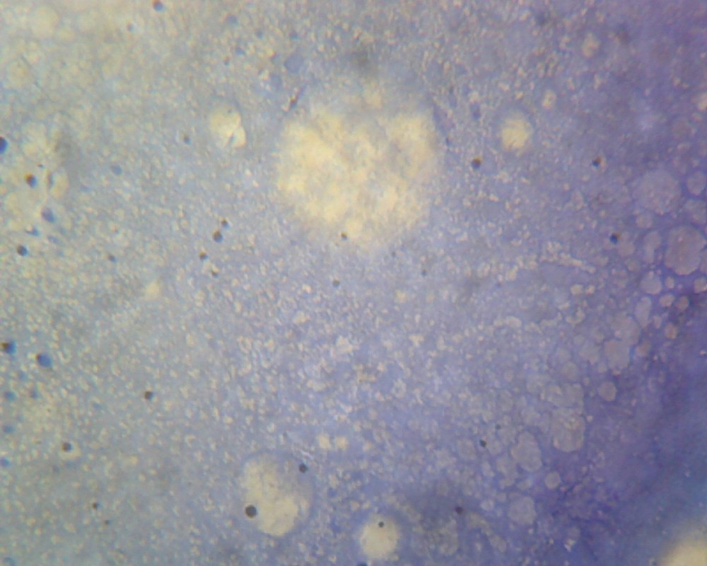 Mycobacterium Tuberculosis; Smear; Gram-Positive