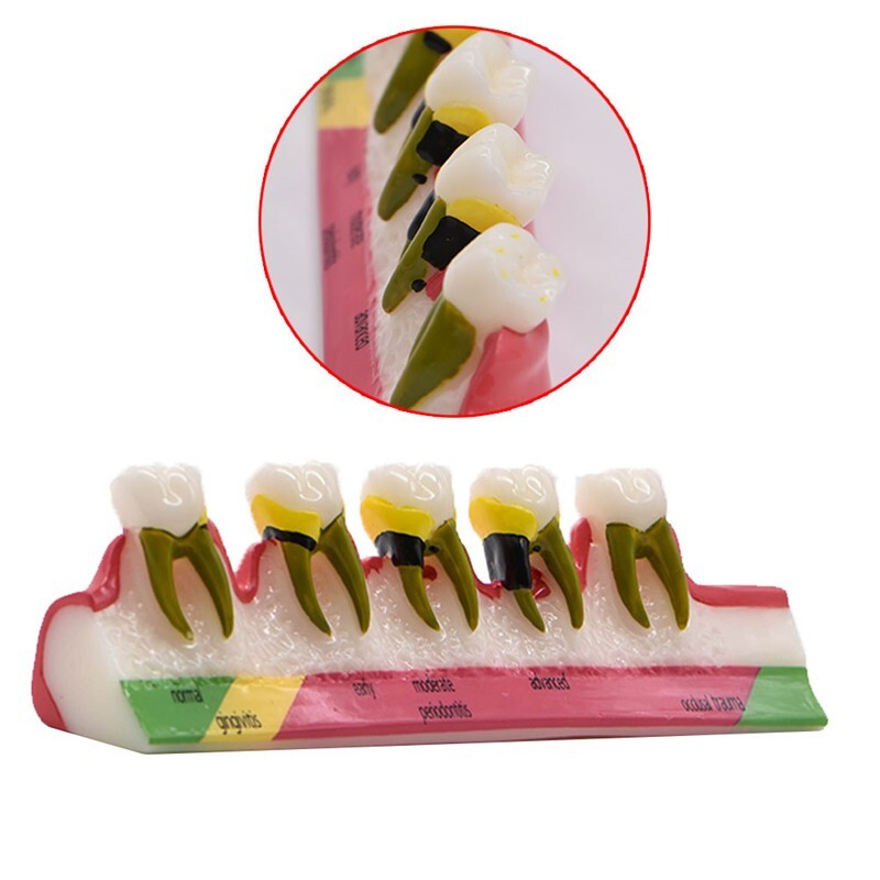 Dental Study Teaching Model Periodontal Disease Assort Teeth Dentoform Typodont