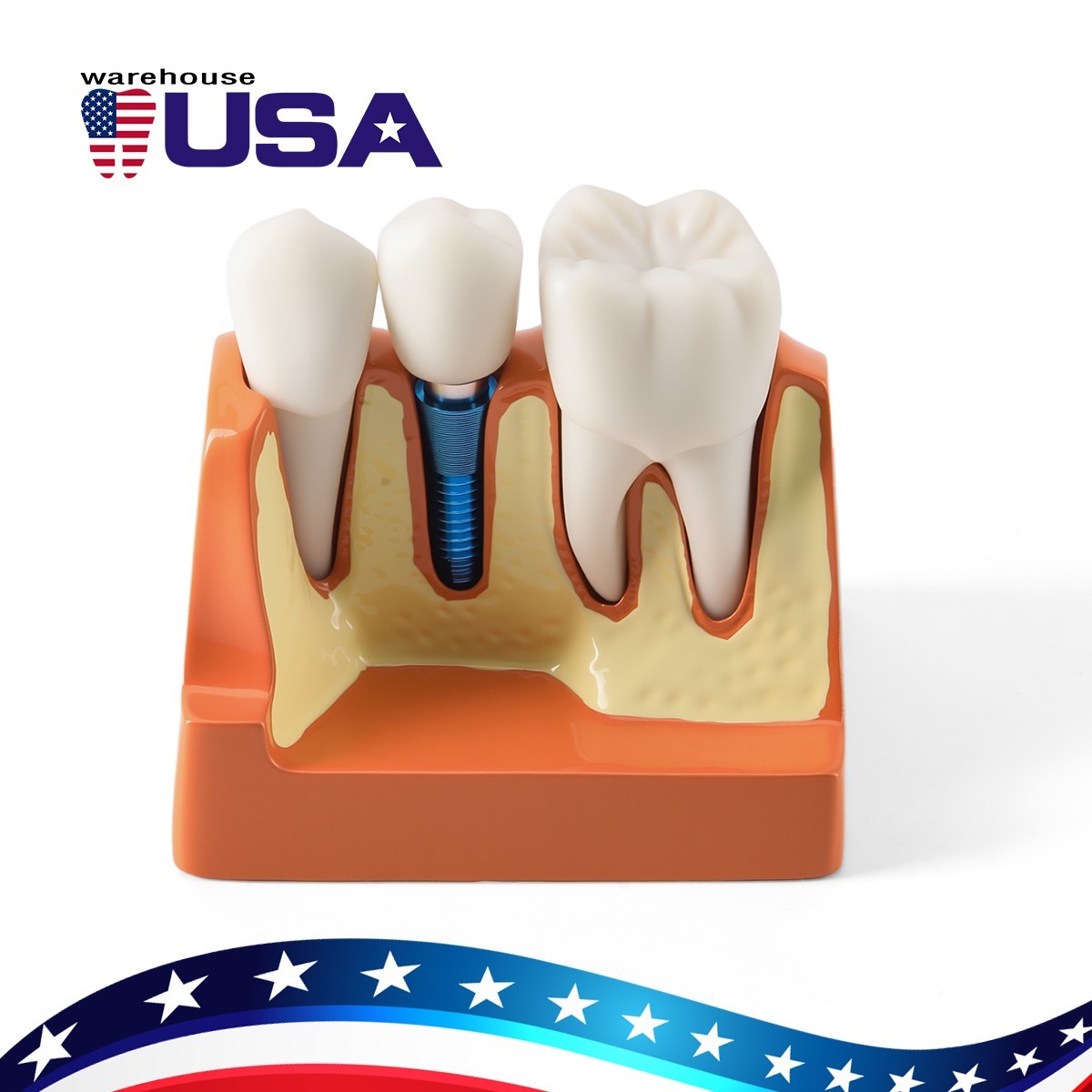 Dental 4 Times Teeth Model Implant Analysis Crown Bridge Demonstration Removable