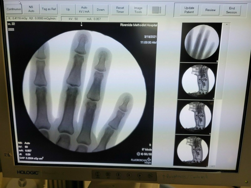 podiatry mini c-arm Hologic insight 2