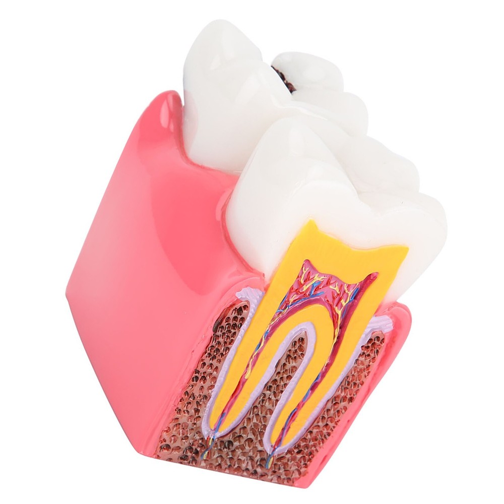 Caries Comparison Study Models Dentist Dental Anatomy Education Teeth Model