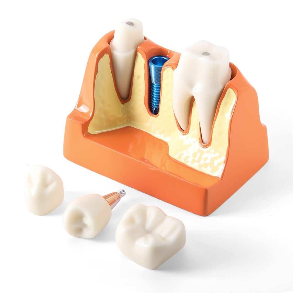 Dental 4Times Teeth Model Implant Analysis Crown Bridge Removable Study Training