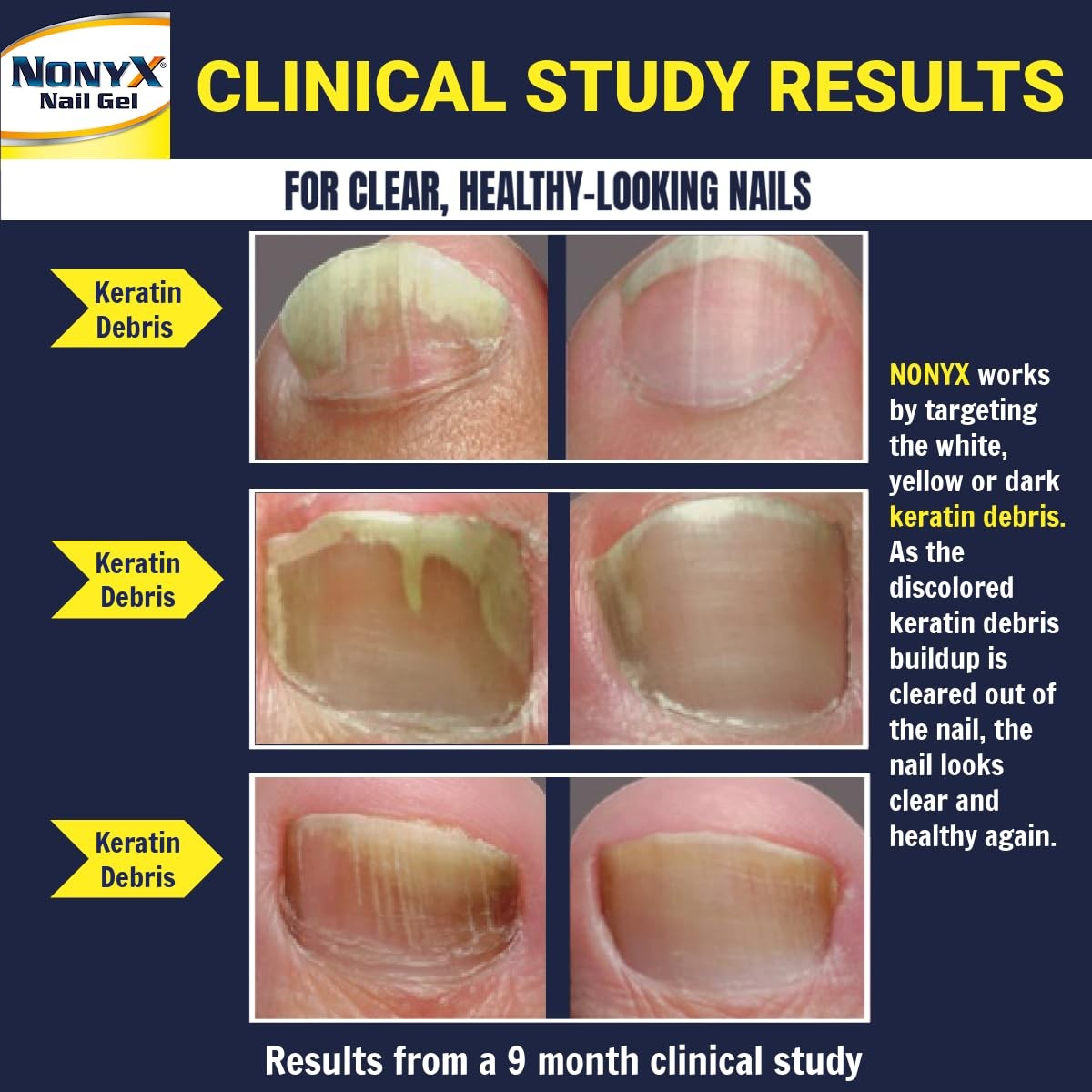 NONYX Fungal Nail Clarifying Gel - Discolored, Thick, Brittle Nails