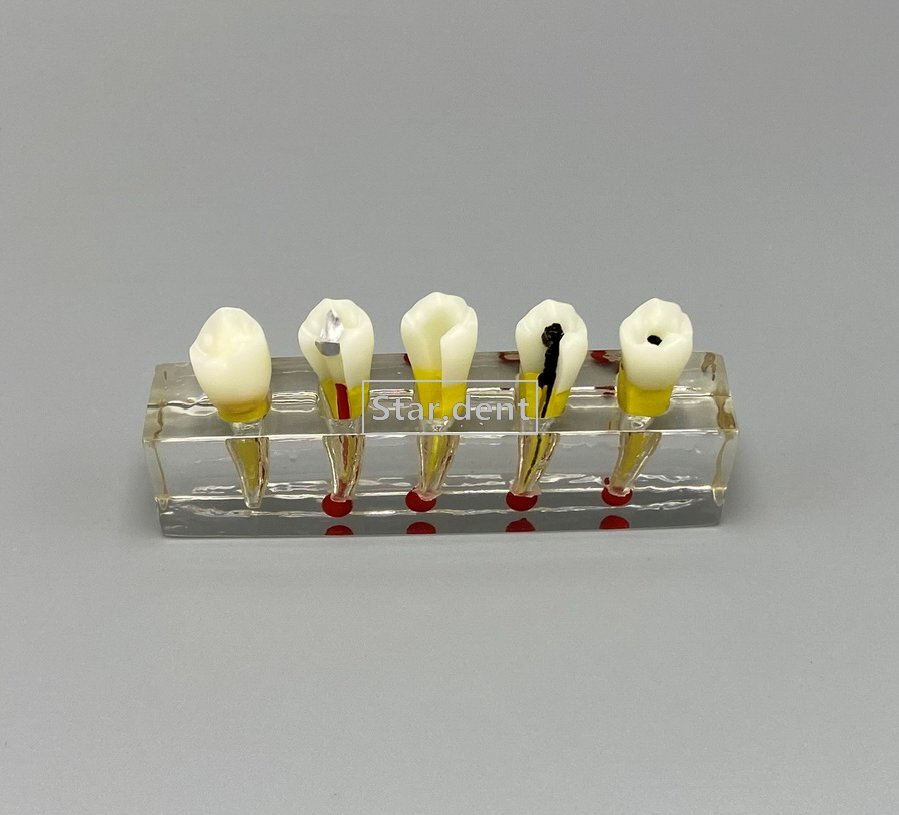 Dental Caries Teeth Model Detachable Abutment Teaching Study Models 4 times