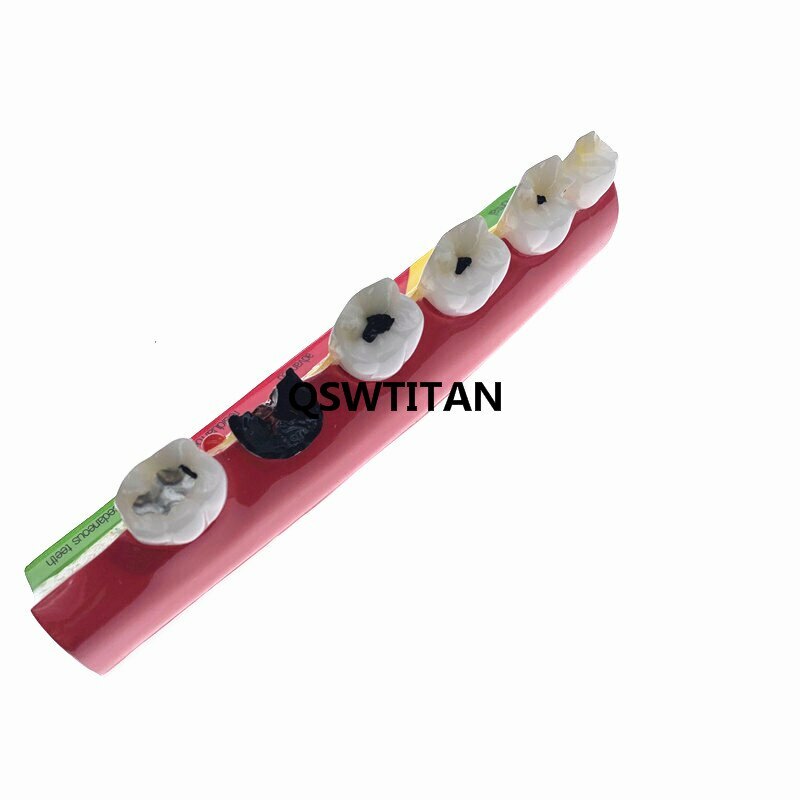 Dental Caries Classify/Evolution model Tooth Model Dental Study Model