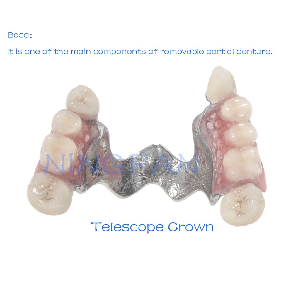 Dental Typodont Removable Partial Denture Model ,PRD Telescopic Crown Denture