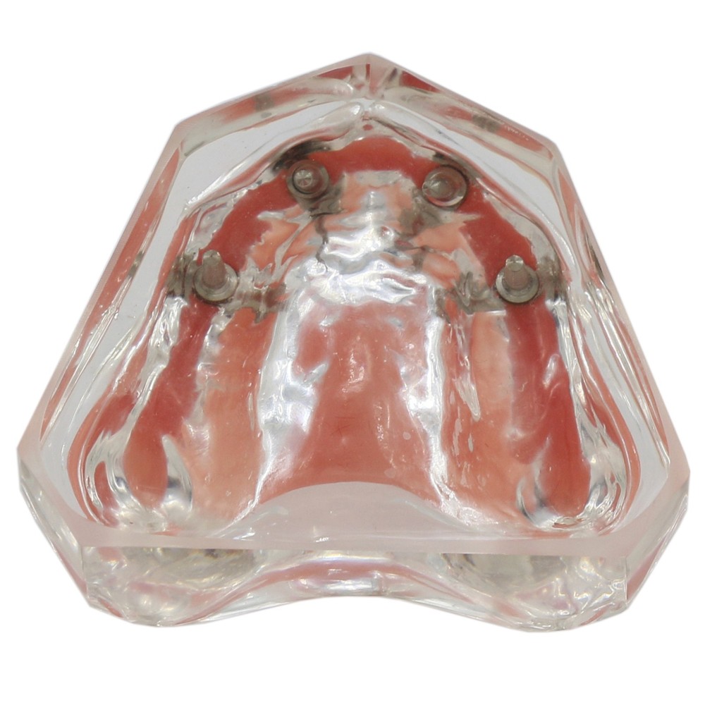 Dental Teeth Model Overdenture Removable Teeth Upper/Lower Jaw 4 Implants Model