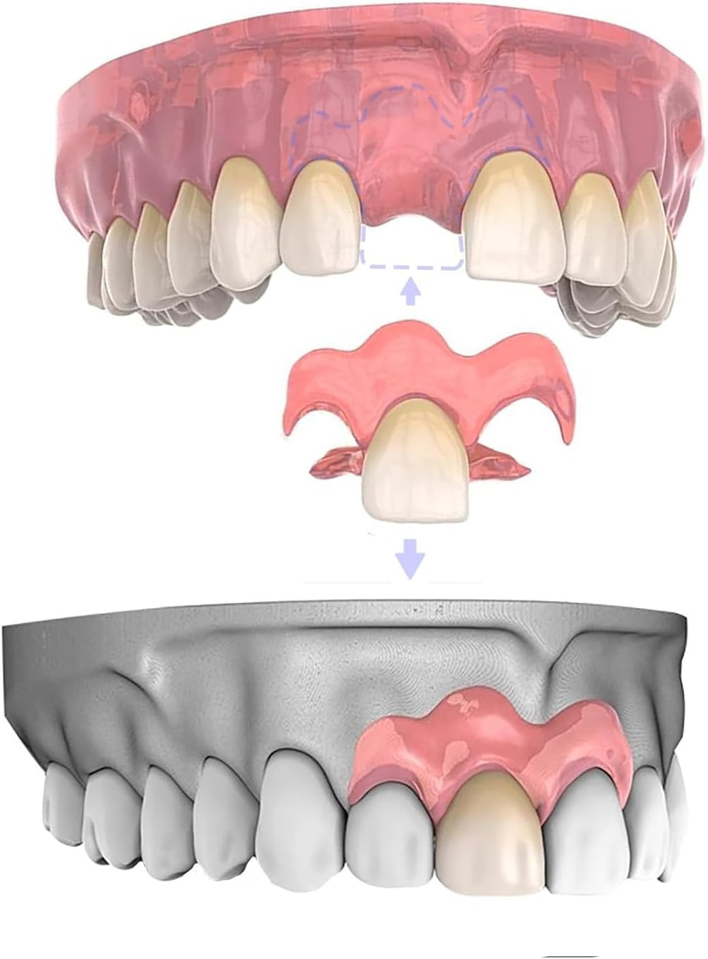 Partial Dentures for Women & Men, Custom Replacement Temporary Flipper Teeth ...