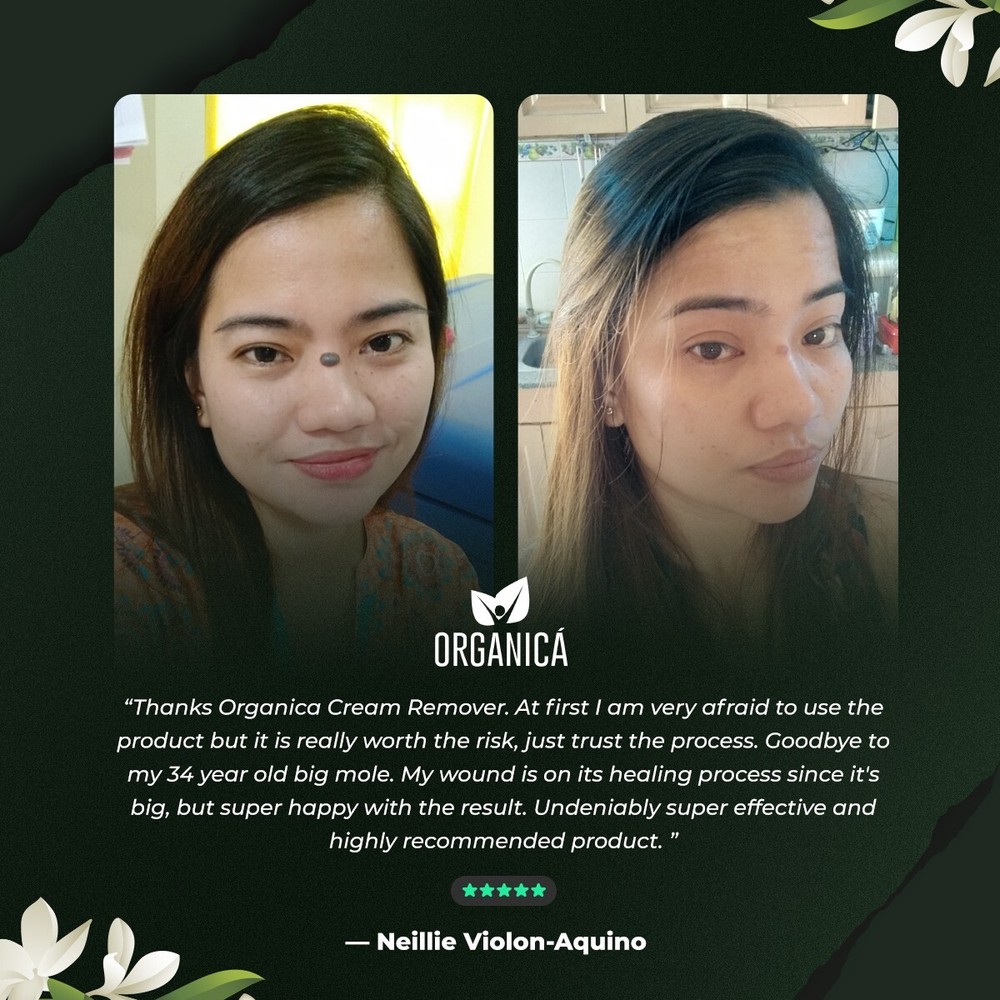 Multi-Awarded Mole and Warts Remover Set