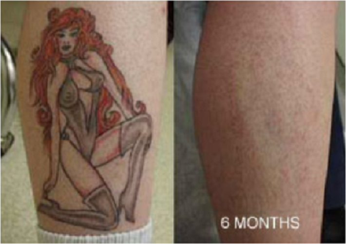 Tattoo Removal Cream Natural Fading system wrecking balm