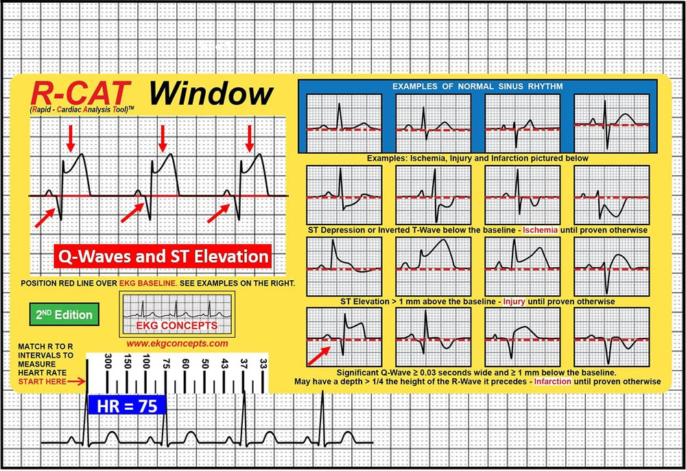 EKG Window: Second Edition