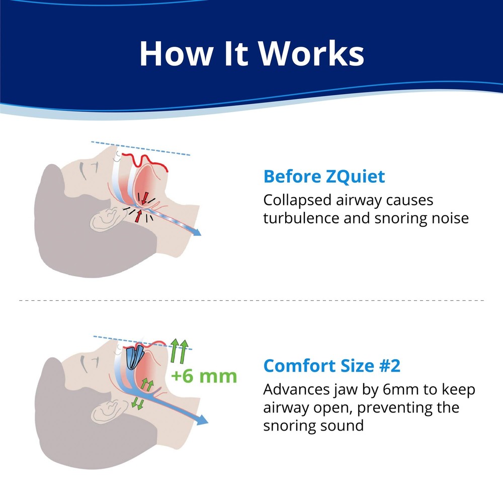 Anti-Snoring Mouthpiece Solution - Comfort Size #2 Single Device