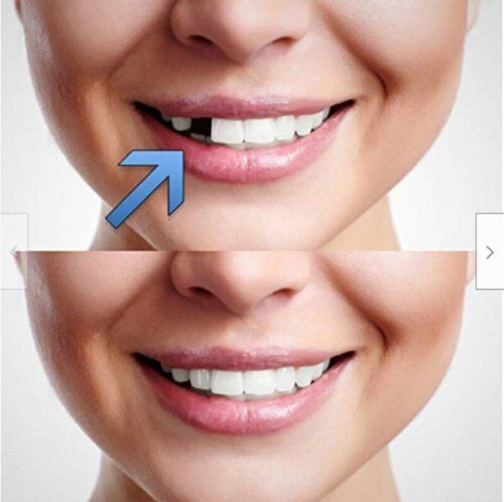 Tooth Repair Kit Temporary Teeth Replacement Beads for Missing & Broken Teeth