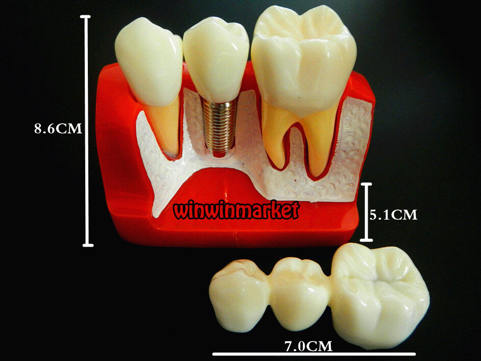 Dental Implant Analysis Crown Bridge Demonstration Teeth Model Remove Teach Lab