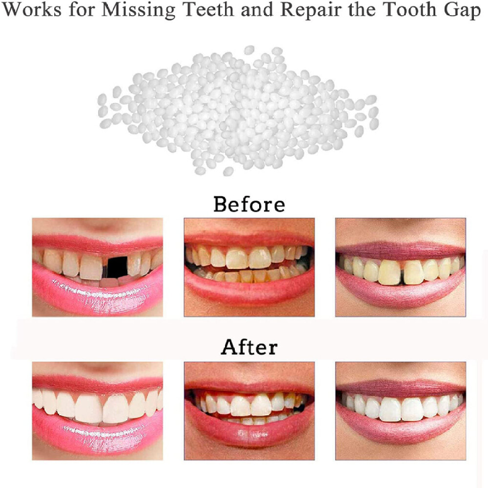 Tooth Repair Kit - Temporary Teeth Replacement Kit for Missing & Broken Teet