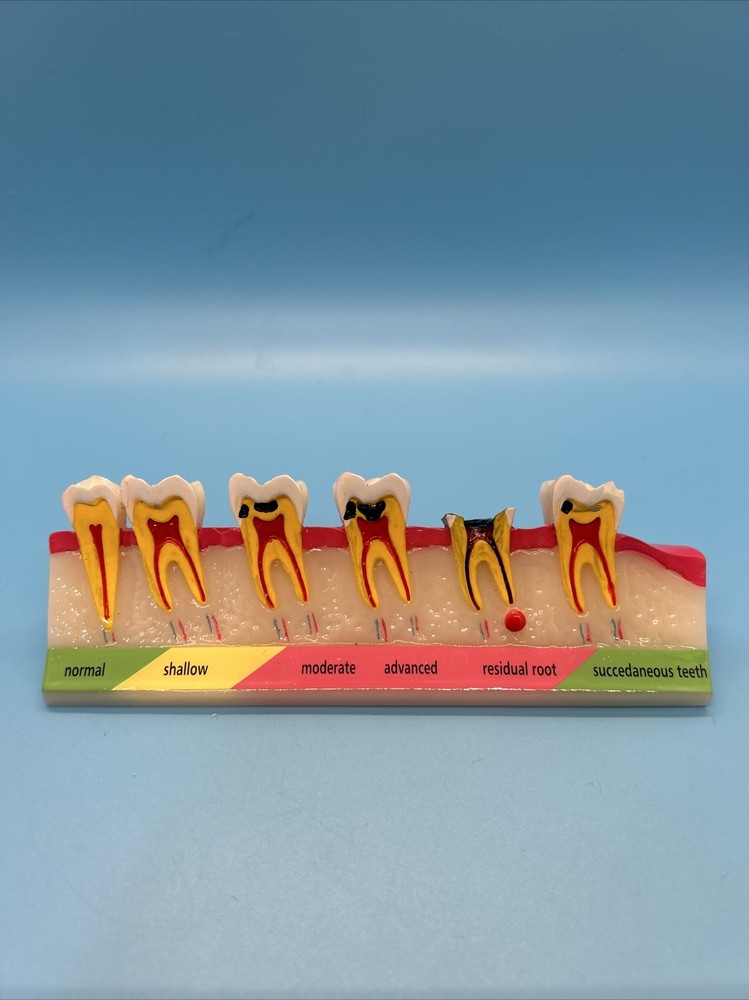 Dental Caries Developing illusteation teeth disease Tooth Model Demonstration