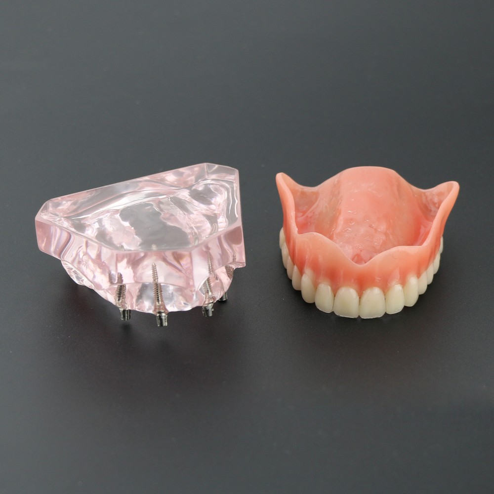 Dental Typodont Teeth Model Superior 4 Implants Overdenture Superior Demo Model