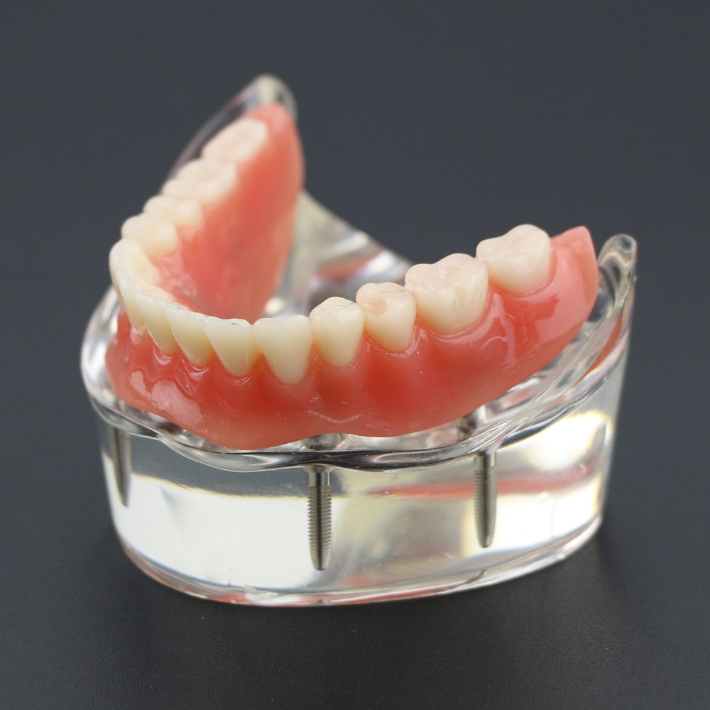 Dental Typodont Lower Teeth Demo Study Model Overdenture Inferior 4 Implants